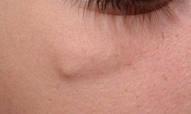 EPIDERMOID CYSTE: på kinnet til 7 år gammel gutt. Foto: NTB Scanpix/Science Photo Library EPIDERMOID CYSTE: på kinnet til 7 år gammel gutt. Foto: NTB Scanpix/Science Photo Library